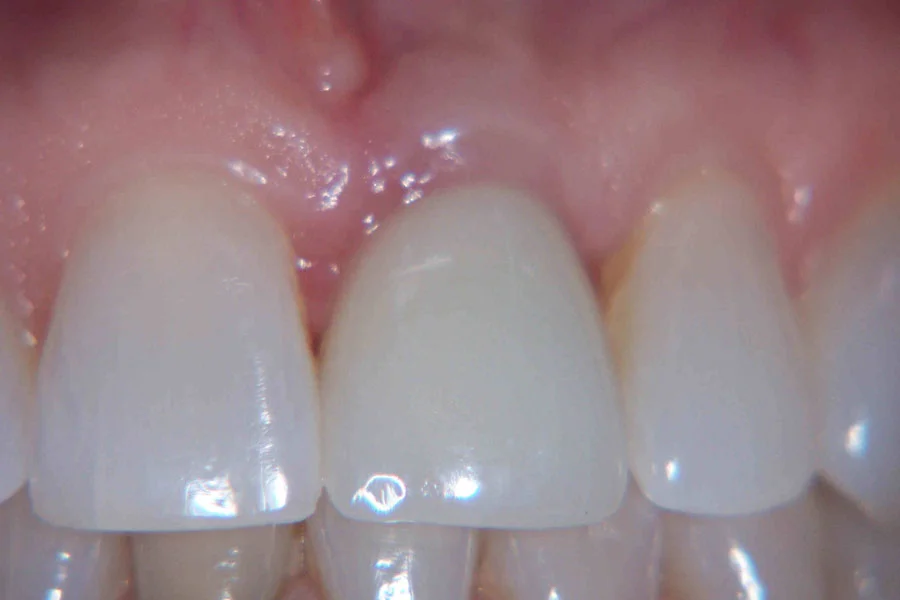 Patient's smile after a single-tooth implant crown