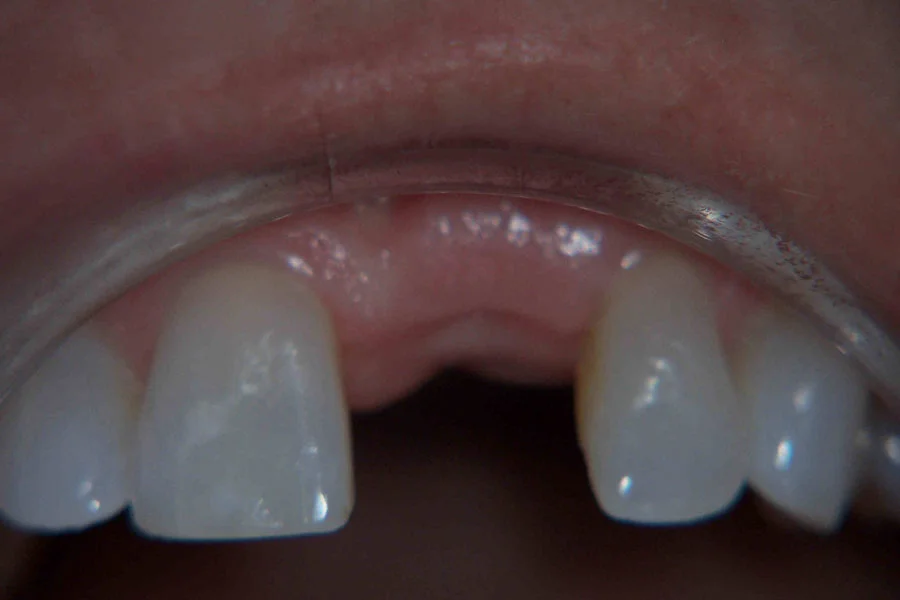 Patient's smile before a single-tooth implant crown
